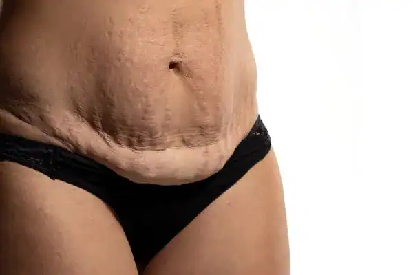 Sagging stomach after extreme weight loss  - HIFU can help!